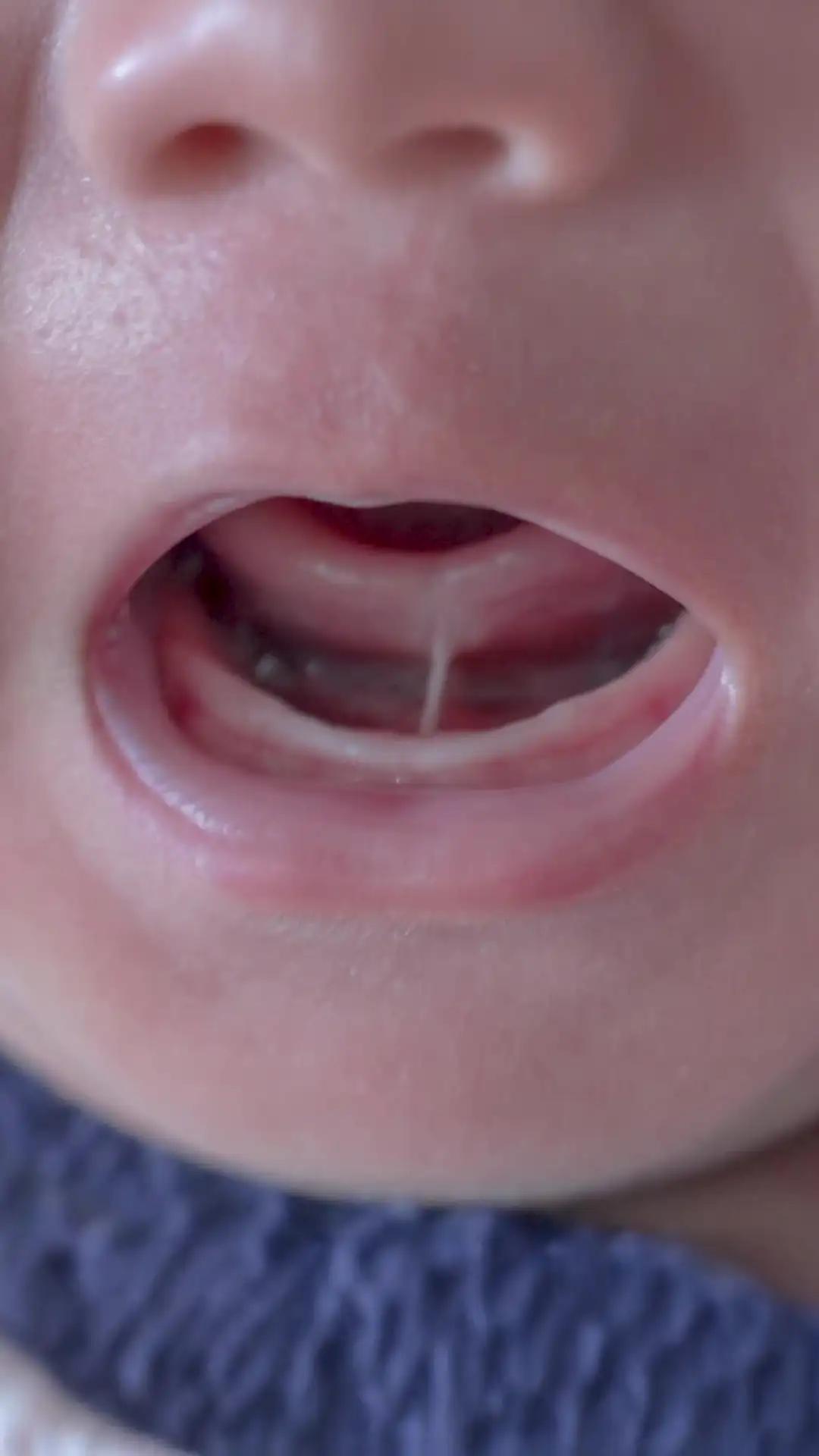 Tongue Tie