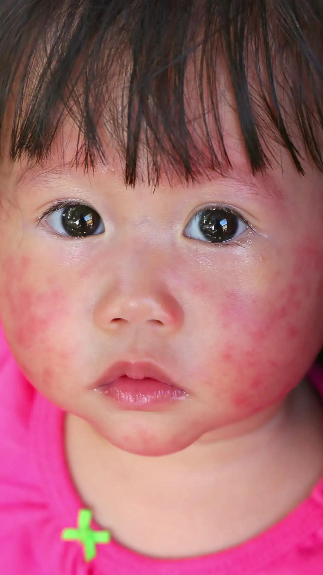 Resiko Alergi Makanan saat MPASI