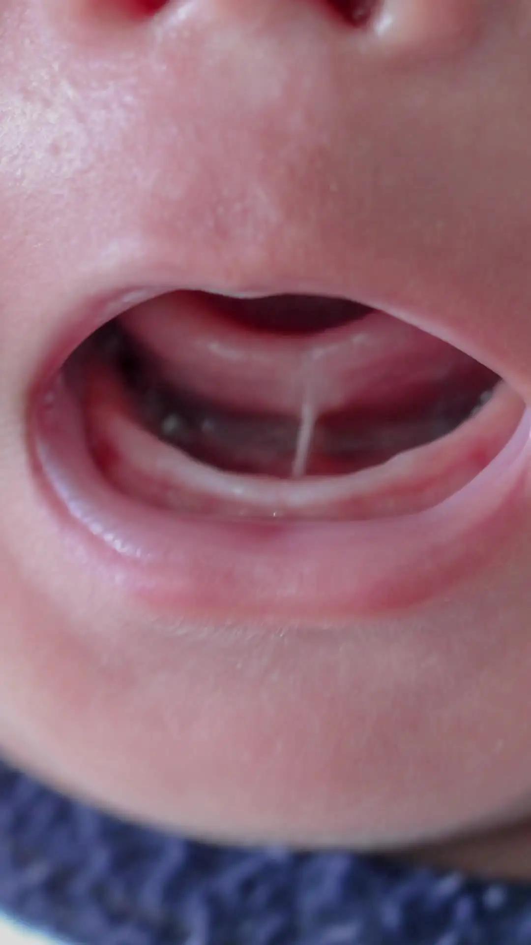 Tongue Tie